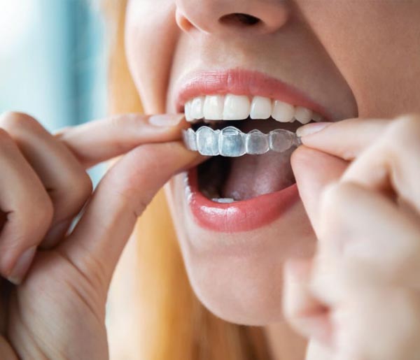 Invisalign